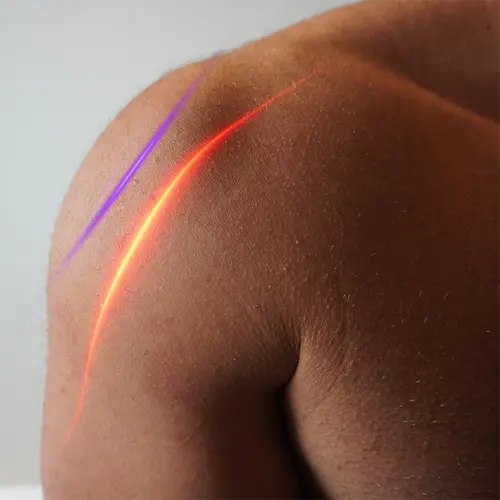Chiropractor applying low level laser therapy during a patient treatment session